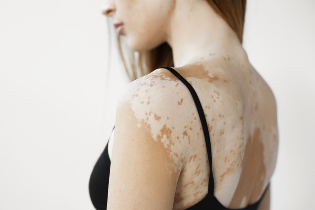 Can vitiligo go away?