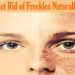 How can I remove freckles permanently?