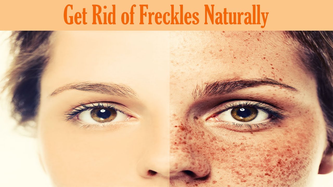 How can I remove freckles permanently?