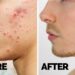 How do I remove acne?