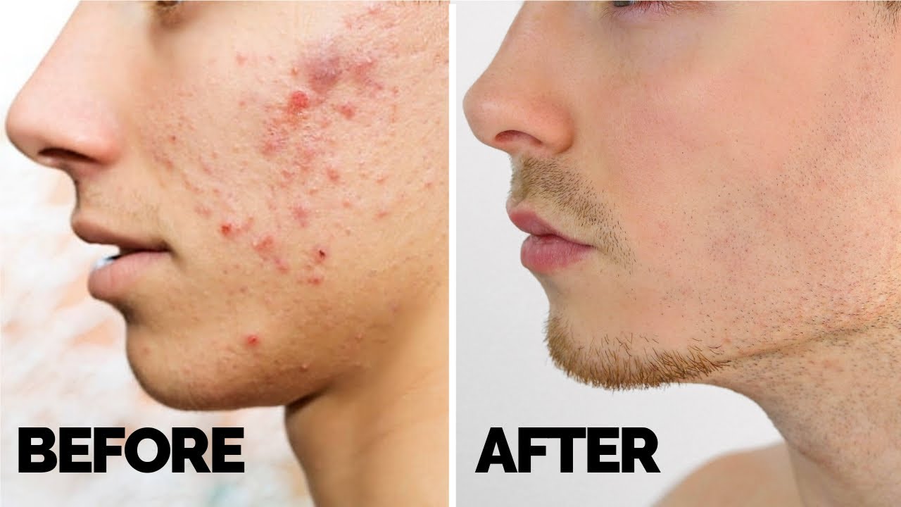 How do I remove acne?