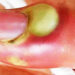 What causes pus?