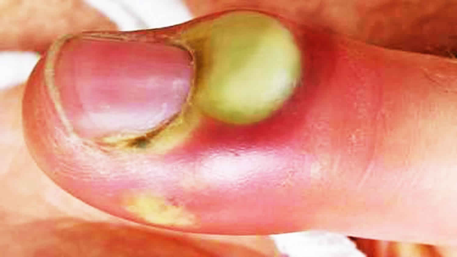 What causes pus?