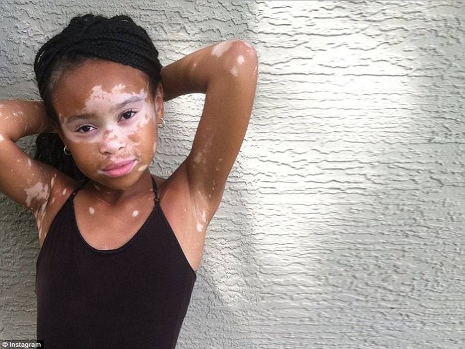 Who is the black model with vitiligo?