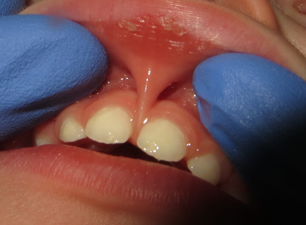 Can lip tie cause gap in teeth?