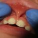 Can lip tie cause gap in teeth?