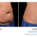 Does CoolSculpting have side effects?