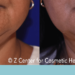 Does CoolSculpting help double chin?