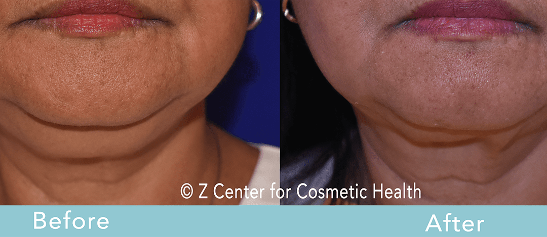 Does CoolSculpting help double chin?