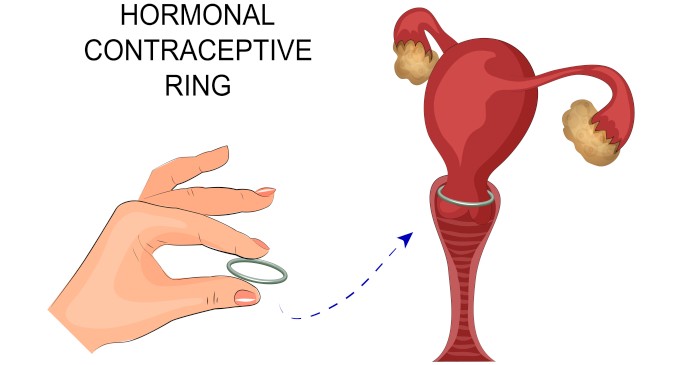 How effective is birth control inside vagina?