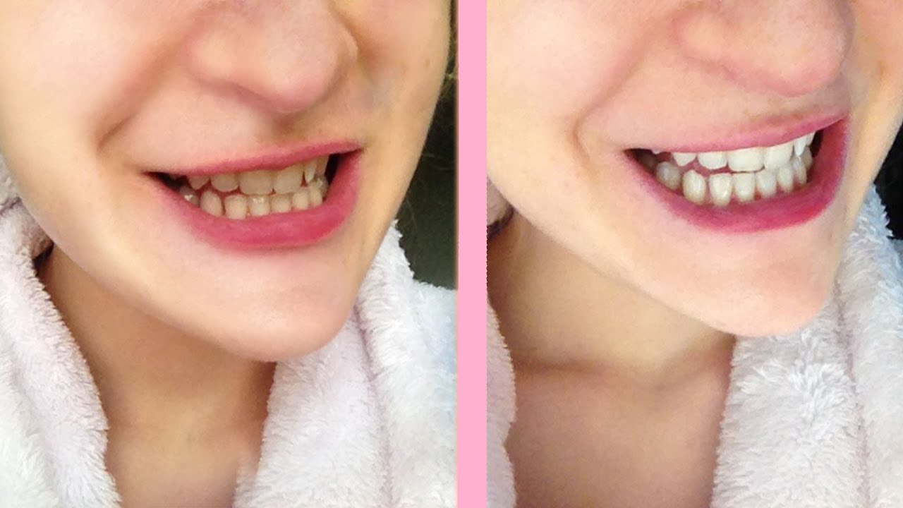 How long does it take to see results with Crest Whitening emulsions?