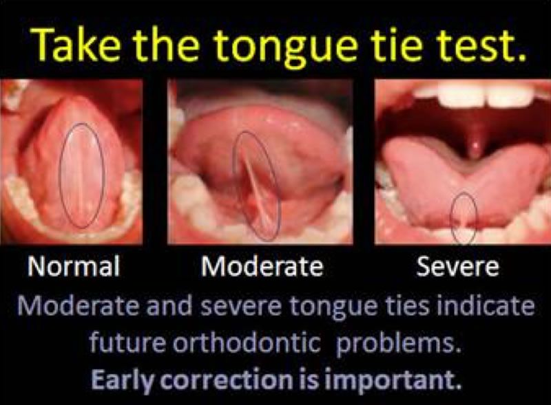 Should I get my toddlers lip tie fixed?