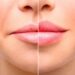 What are the long term effects of a lip tie?