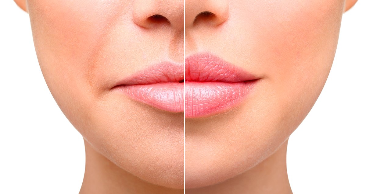 What are the long term effects of a lip tie?