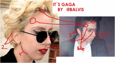 What disease does Lady Gaga have?