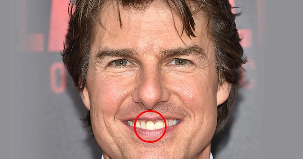 What disease does Tom Cruise have?